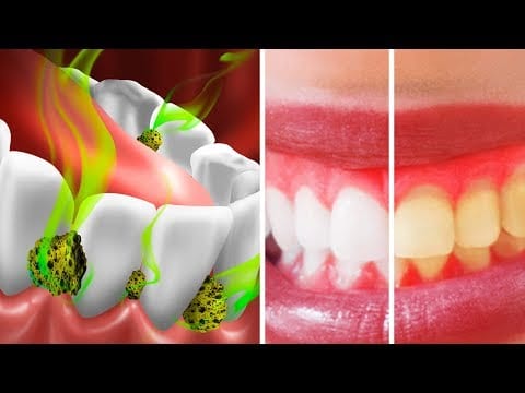 10 Ways to Stop Bad Breath and Get Rid of Mouth Bacteria