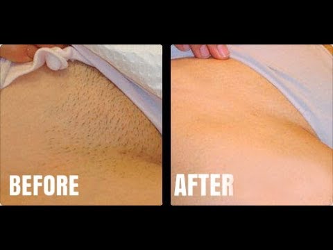 How To Properly Remove Pubic Hair | No More Ingrown Hairs, Bumps or Dark Spots!