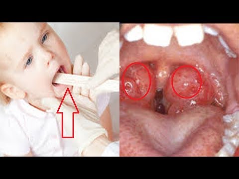 How to Get Rid Enlarged Adenoids in Children at Home without Crying !