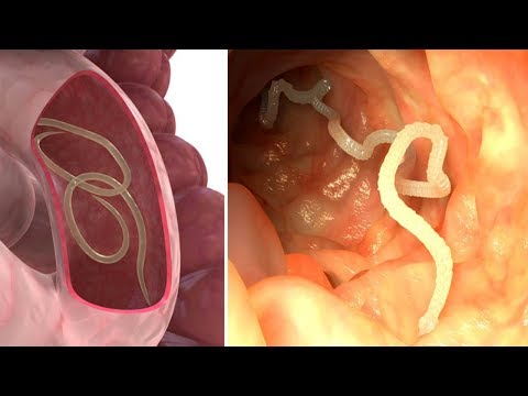 Natural Parasite Cleanse to get rid of intestinal worms