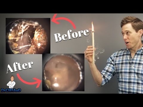 Do Ear Candles Work To Remove Earwax? | Ear Candling Proof!