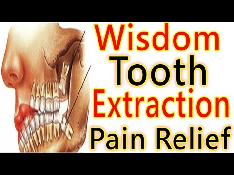 Wisdom Tooth Extraction Pain – How to Deal with Wisdom Teeth Removal Pain -Wisdom Teeth Surgery Pain