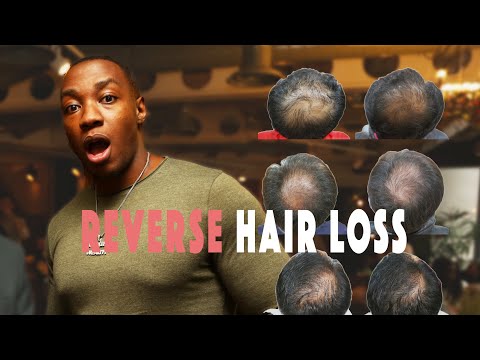 HERBS & oils for hair loss + HOW to regrow your hairline